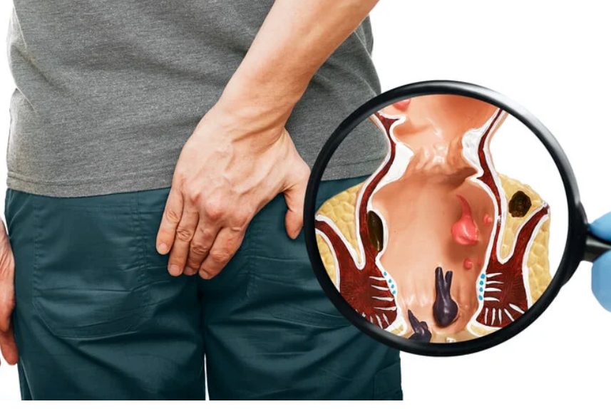 Piles Problem Ayurvedic Care